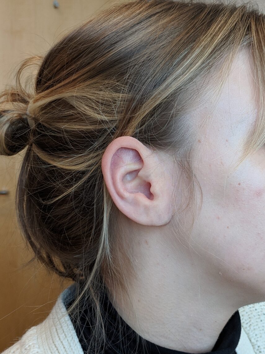 girl with ear prosthesis over microtia ear