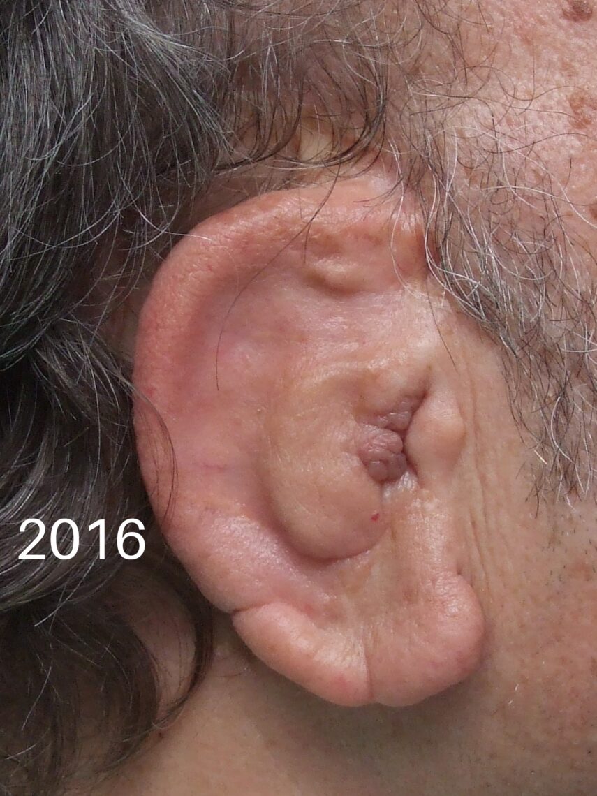 bad ear reconsruction
