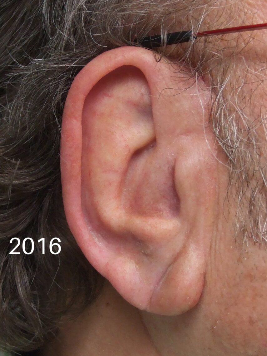 ear prosthetic for bad ear recostruction