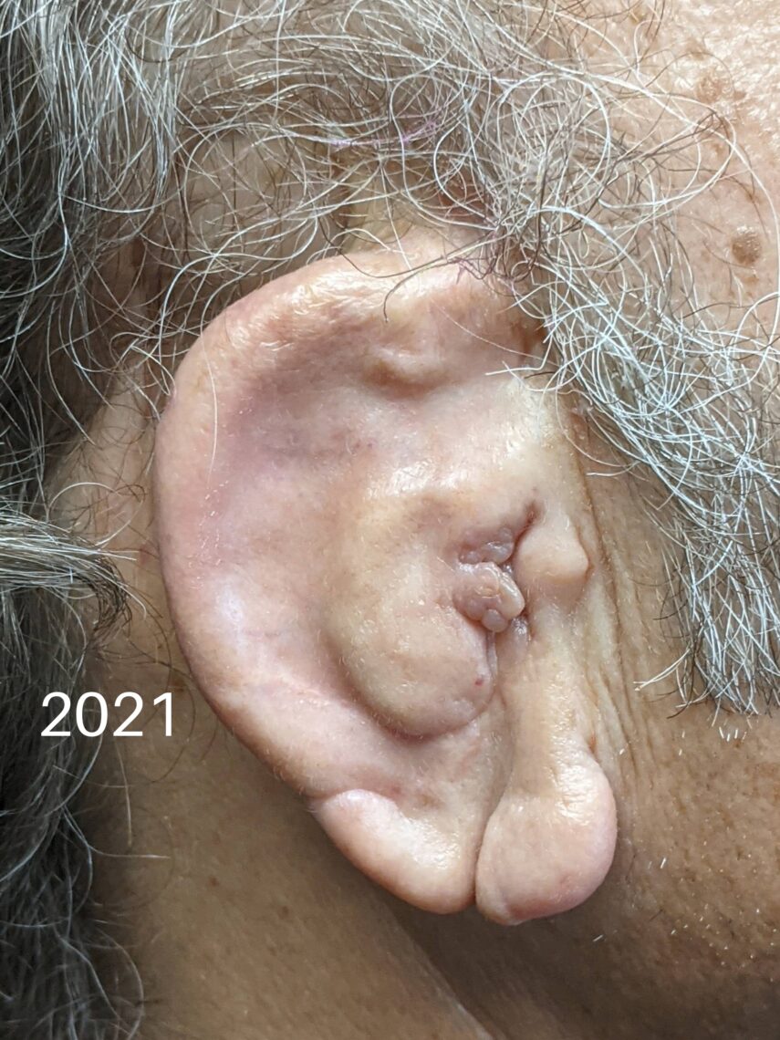 surgical ear reconstruction photo