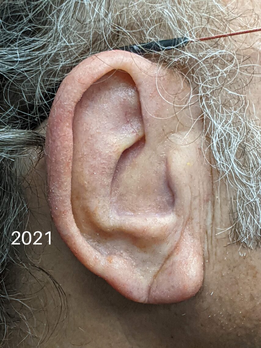 prosthetic ear over bad ear reconstruction