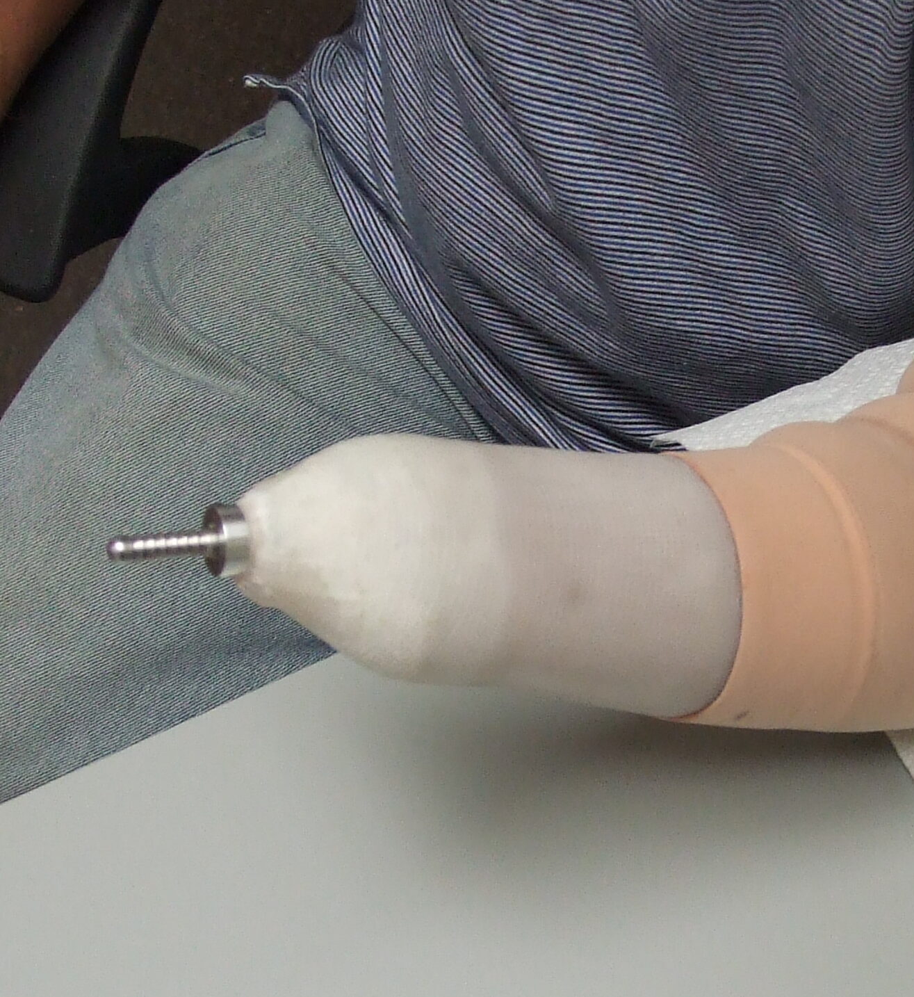 pin lock prosthesis liner on transradial amputation