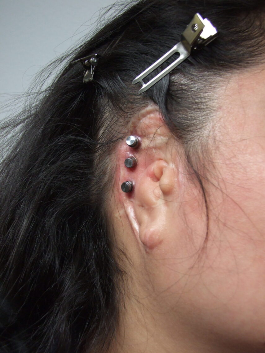 prosthetic ear magnets