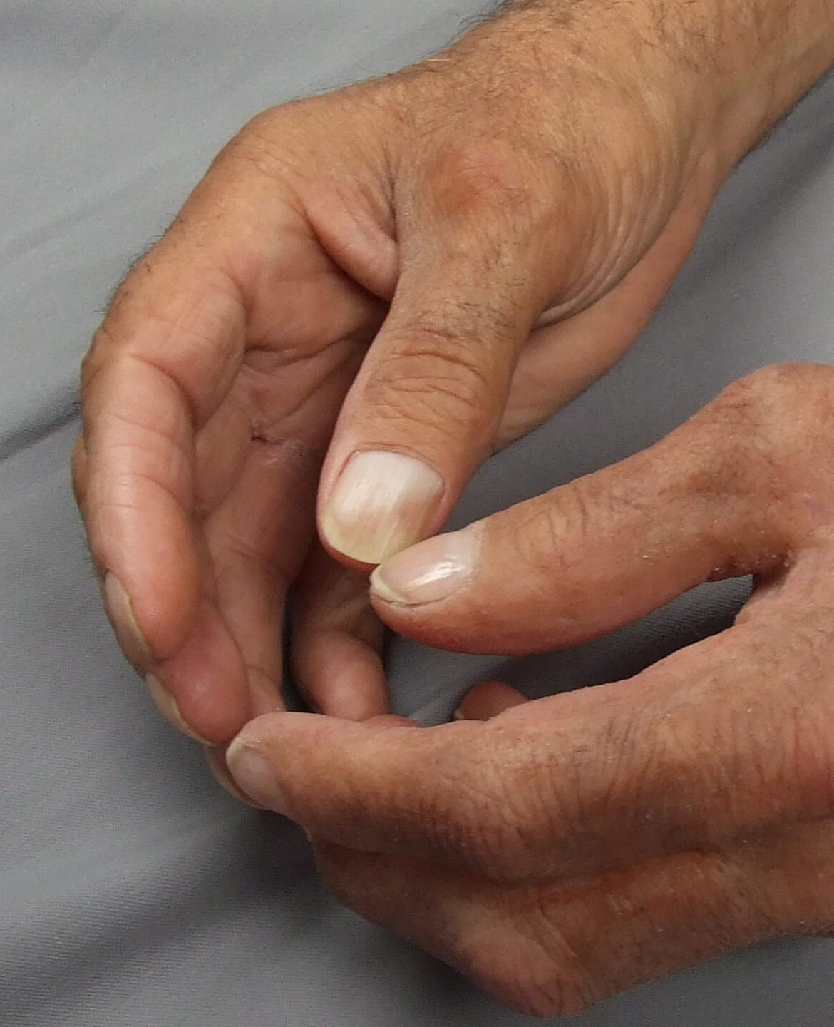 close up of closely matching skin tones in prosthetic hand