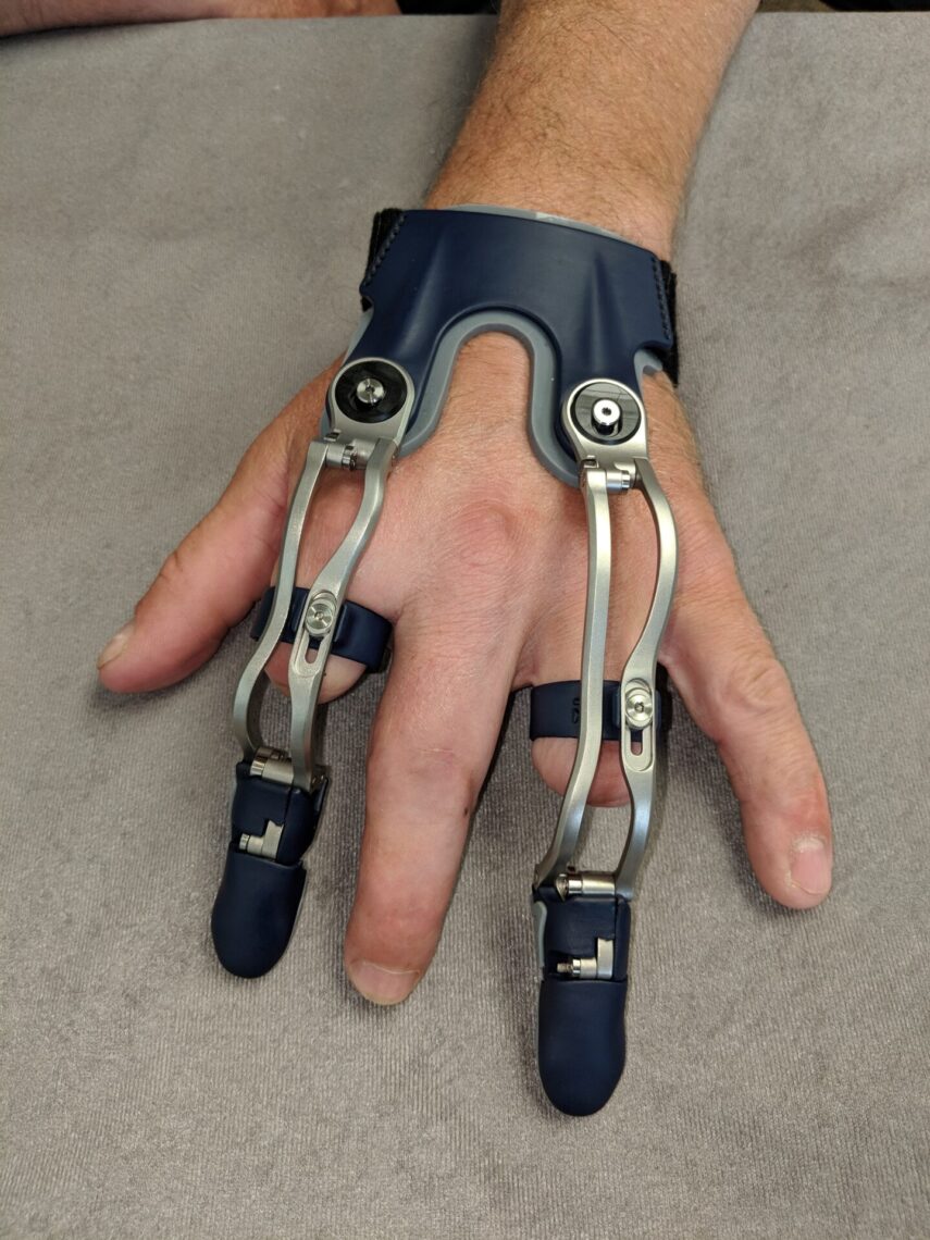 functioning prosthetic fingers