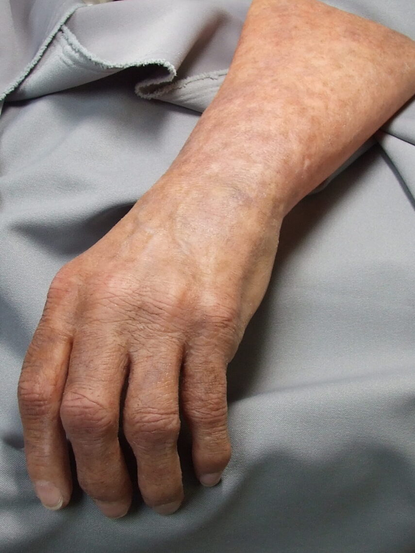 close up of detailed silicone arm prosthesis
