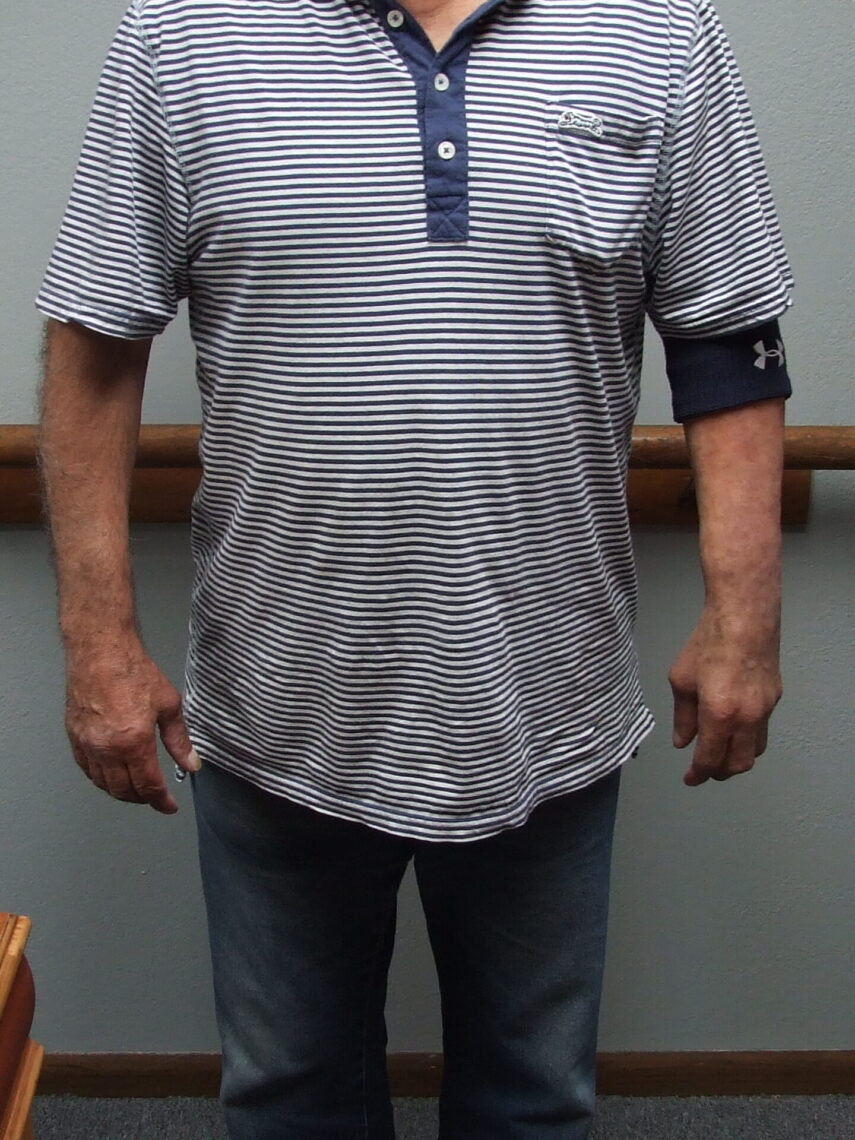 front view if man wearing lifelike silicone arm prosthesis