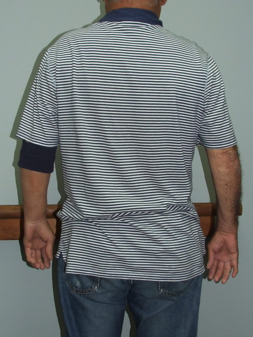 man with arm prosthesis