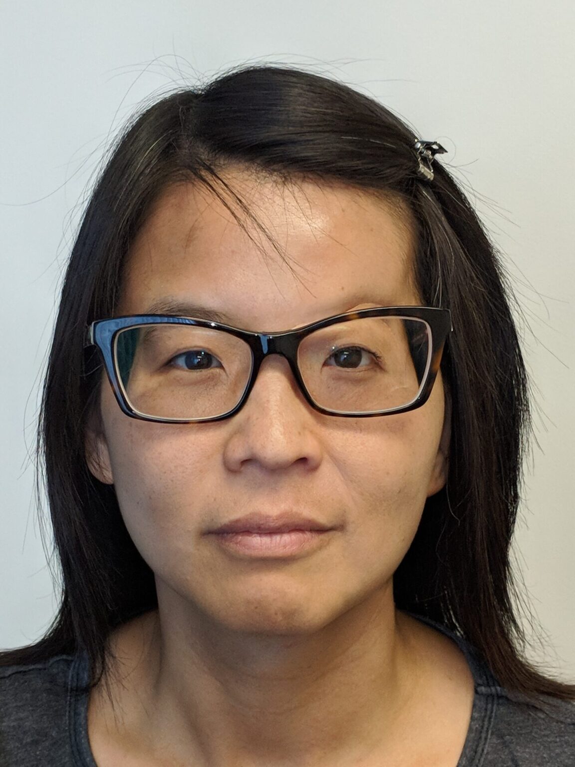 Asian woman wearing eye orbital prosthesis easily attached to her glasses