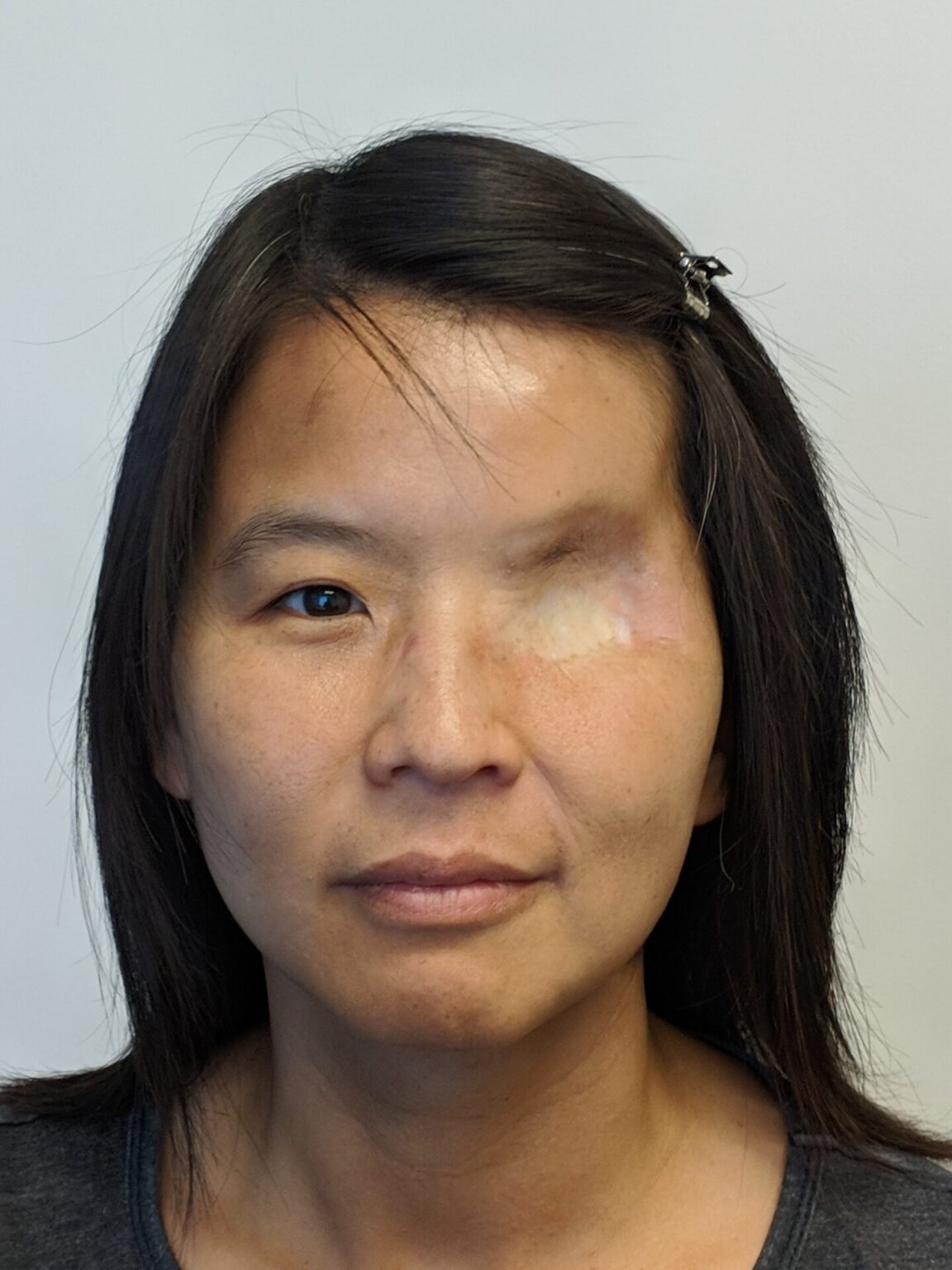 Asian woman withe orbital exenteration