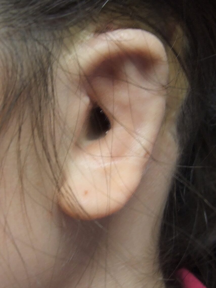 poor autologous left ear reconstruction