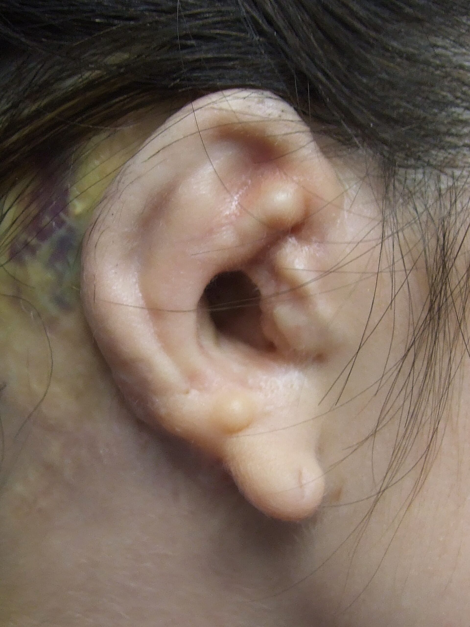poor autologous right ear reconstruction