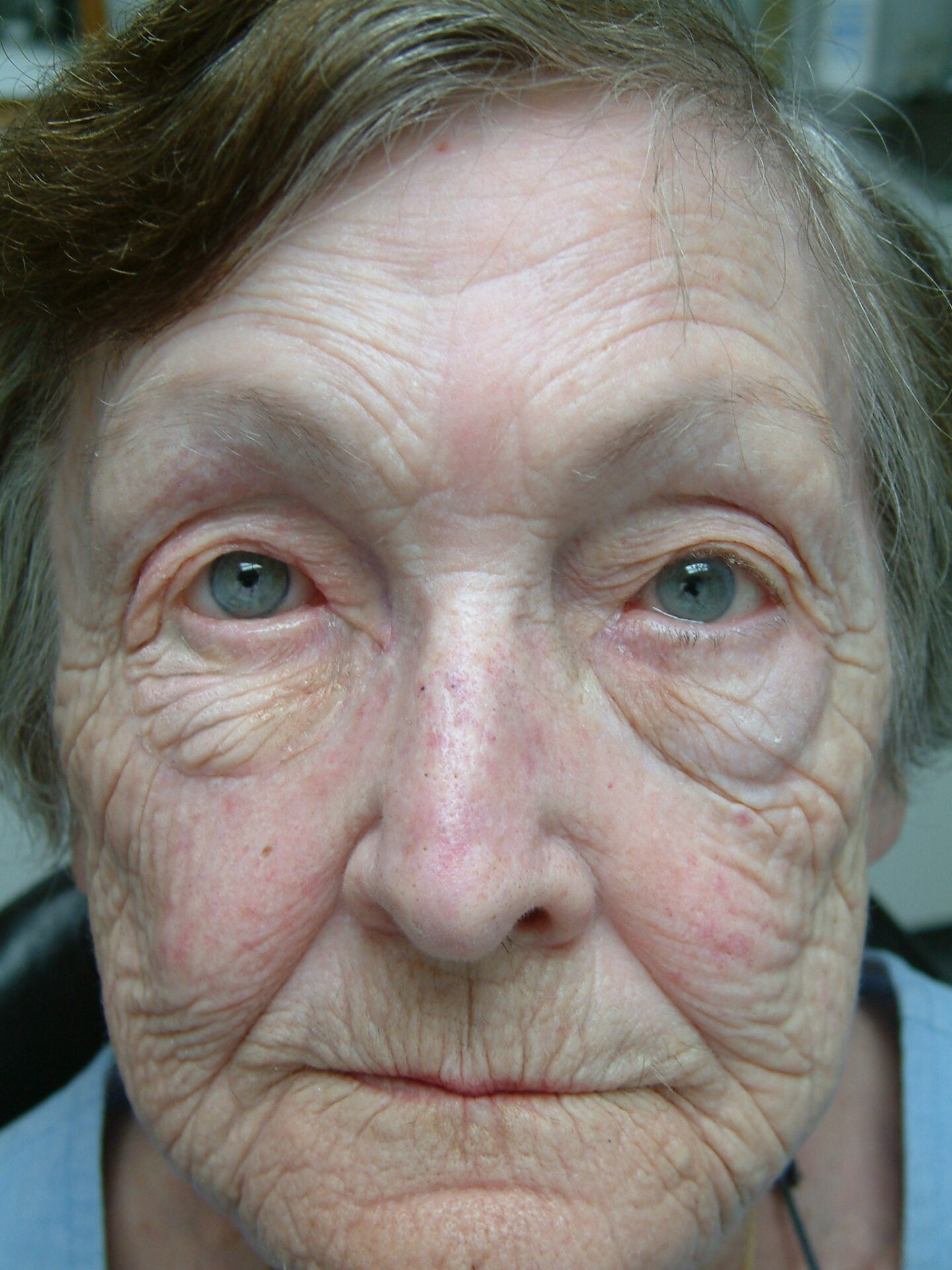 freshly tinted orbital prosthesis in situ