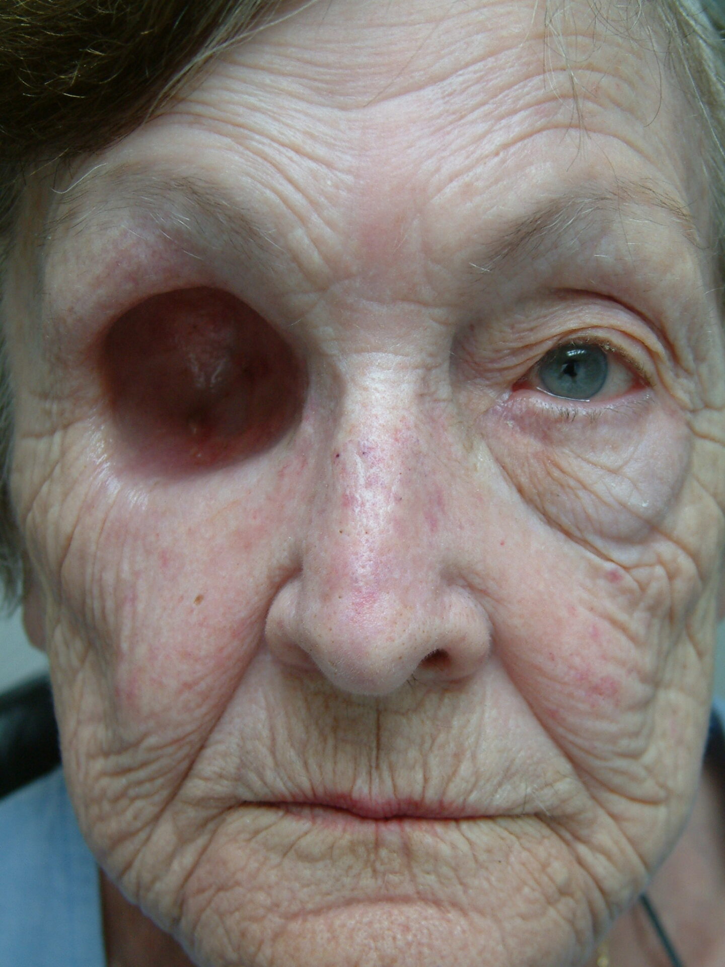 well lined exenteration cavity with undercut areas for retention