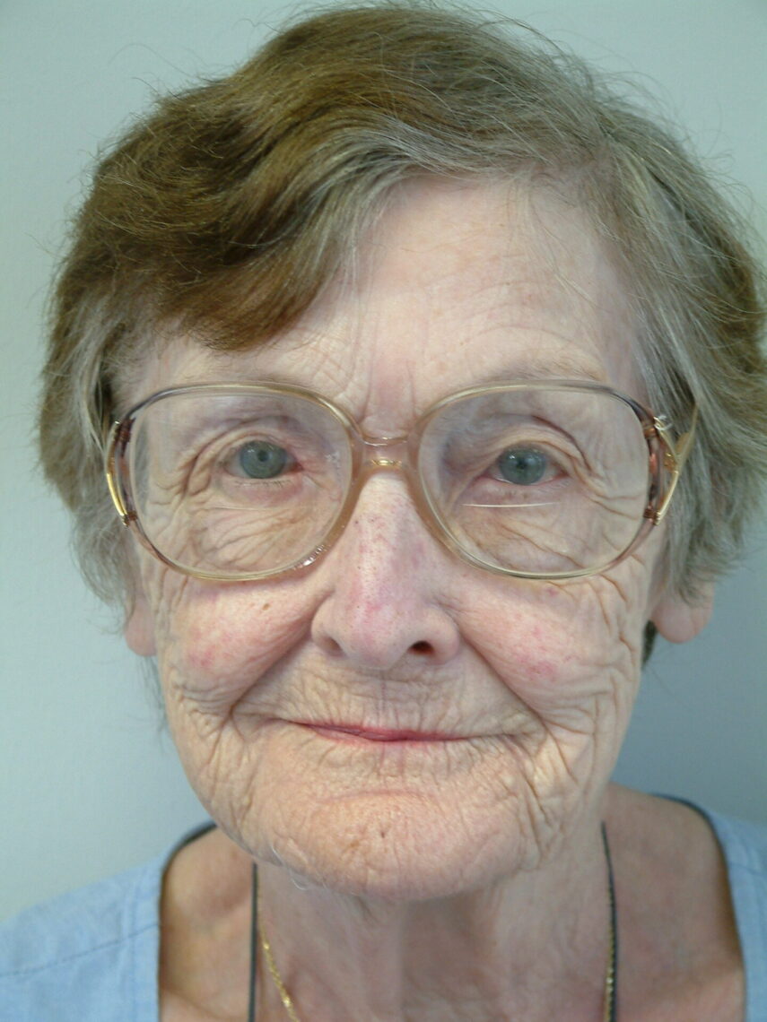 woman with secure easy to wear orbital prosthesis