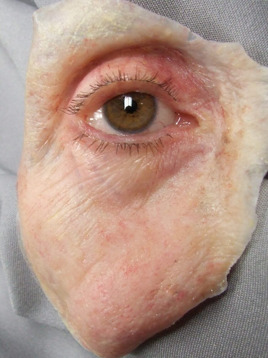 large silicone facial moulage prosthesis with ocular