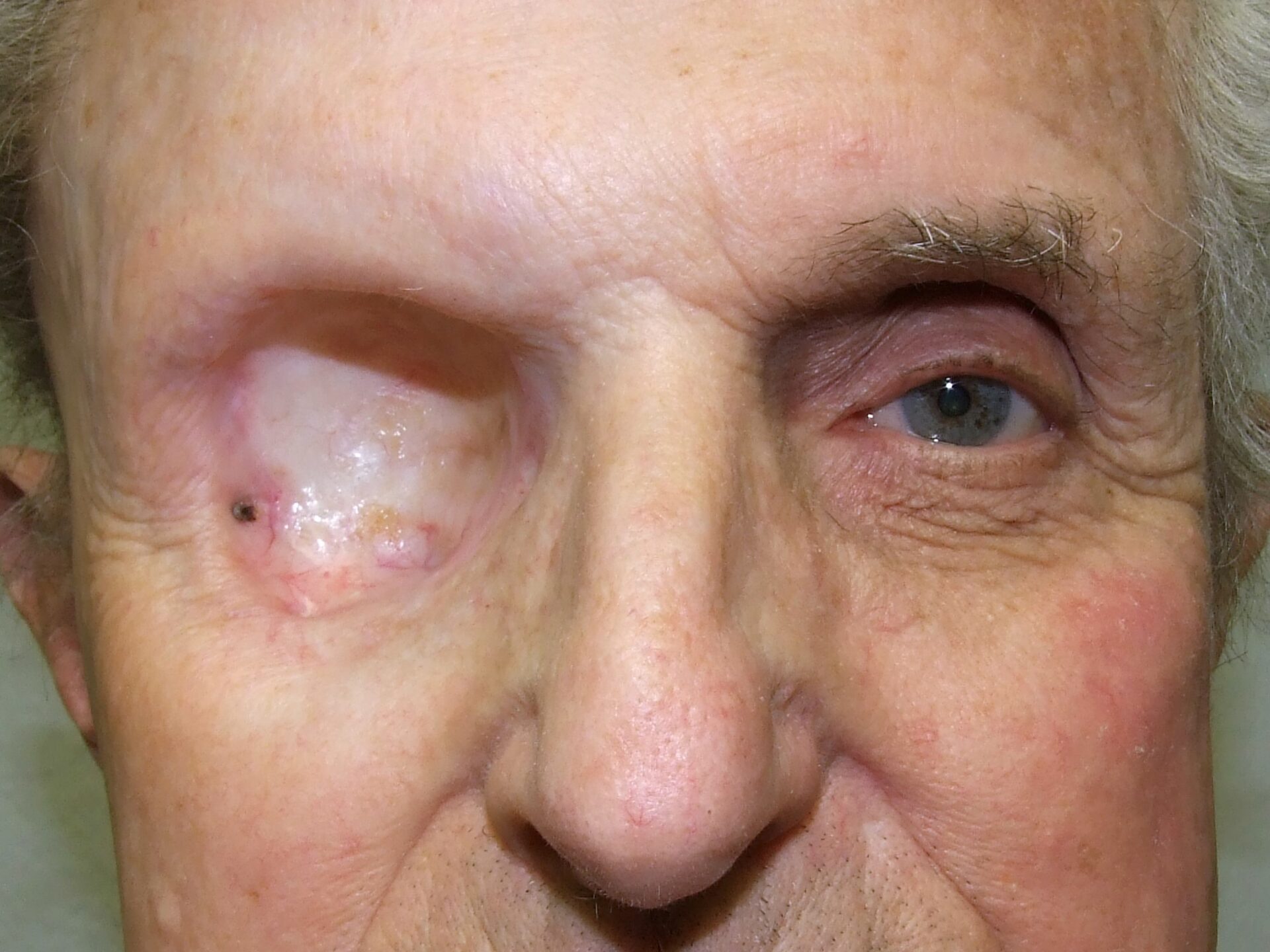 man with orbital exenteration