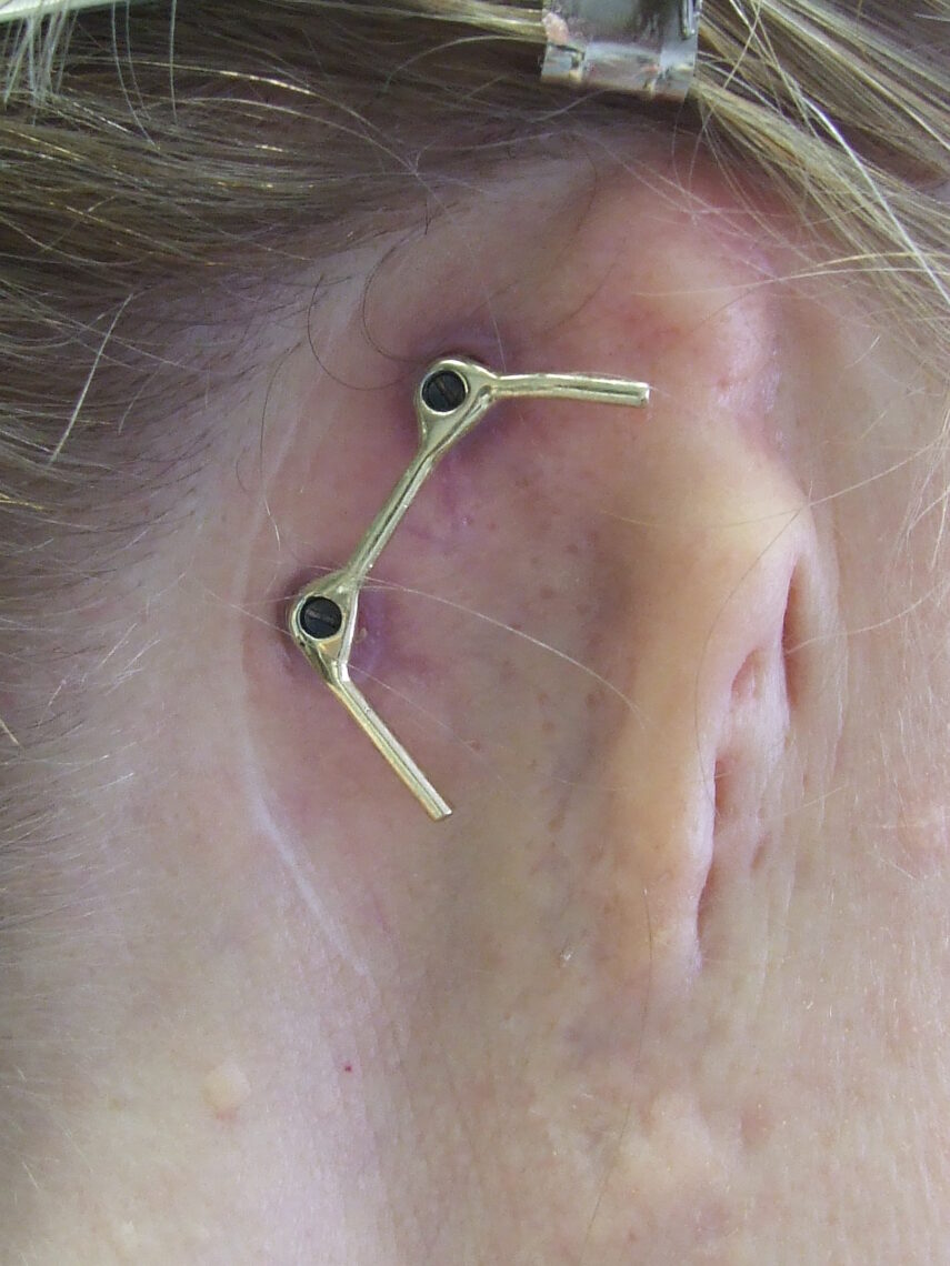 osseointegrated bar to attach prosthetic ear with clips