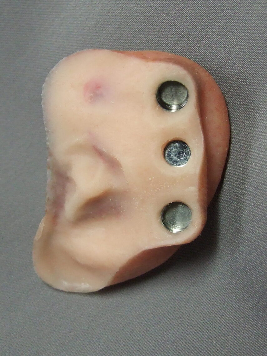 backside prosthetic ear