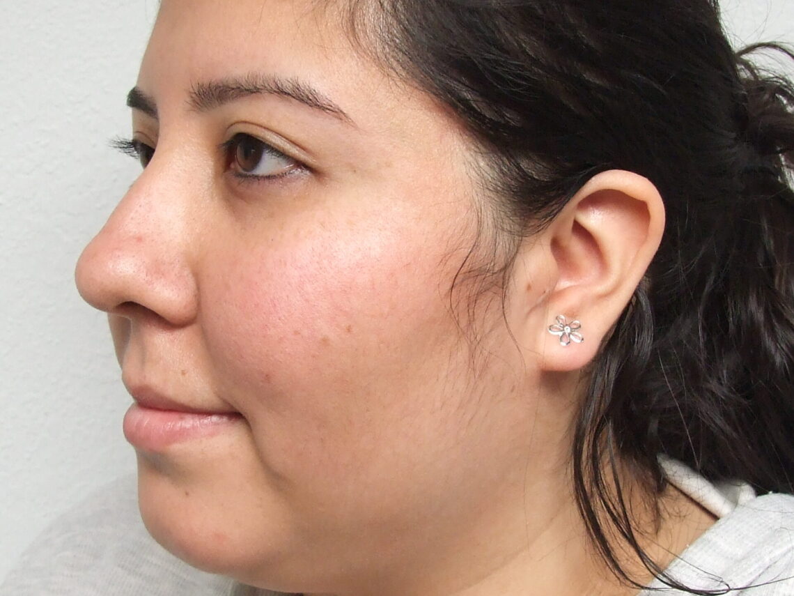 prosthetic ear after