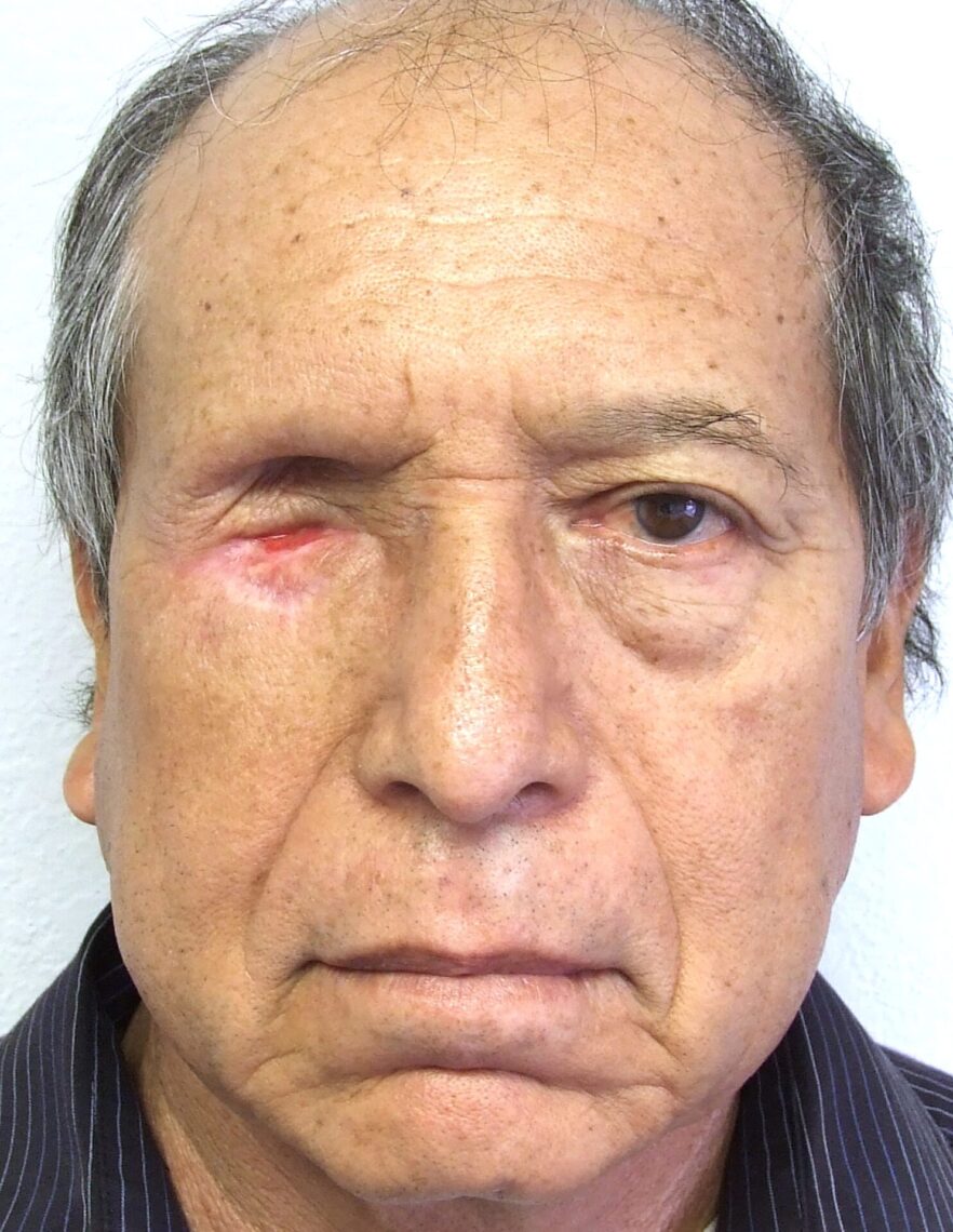 man with complicated enucleation