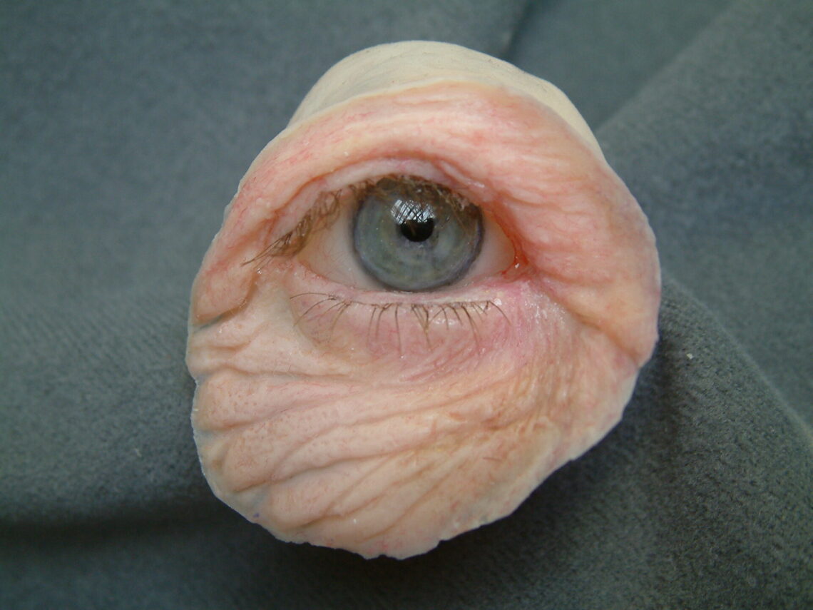 lightweight orbital prosthesis