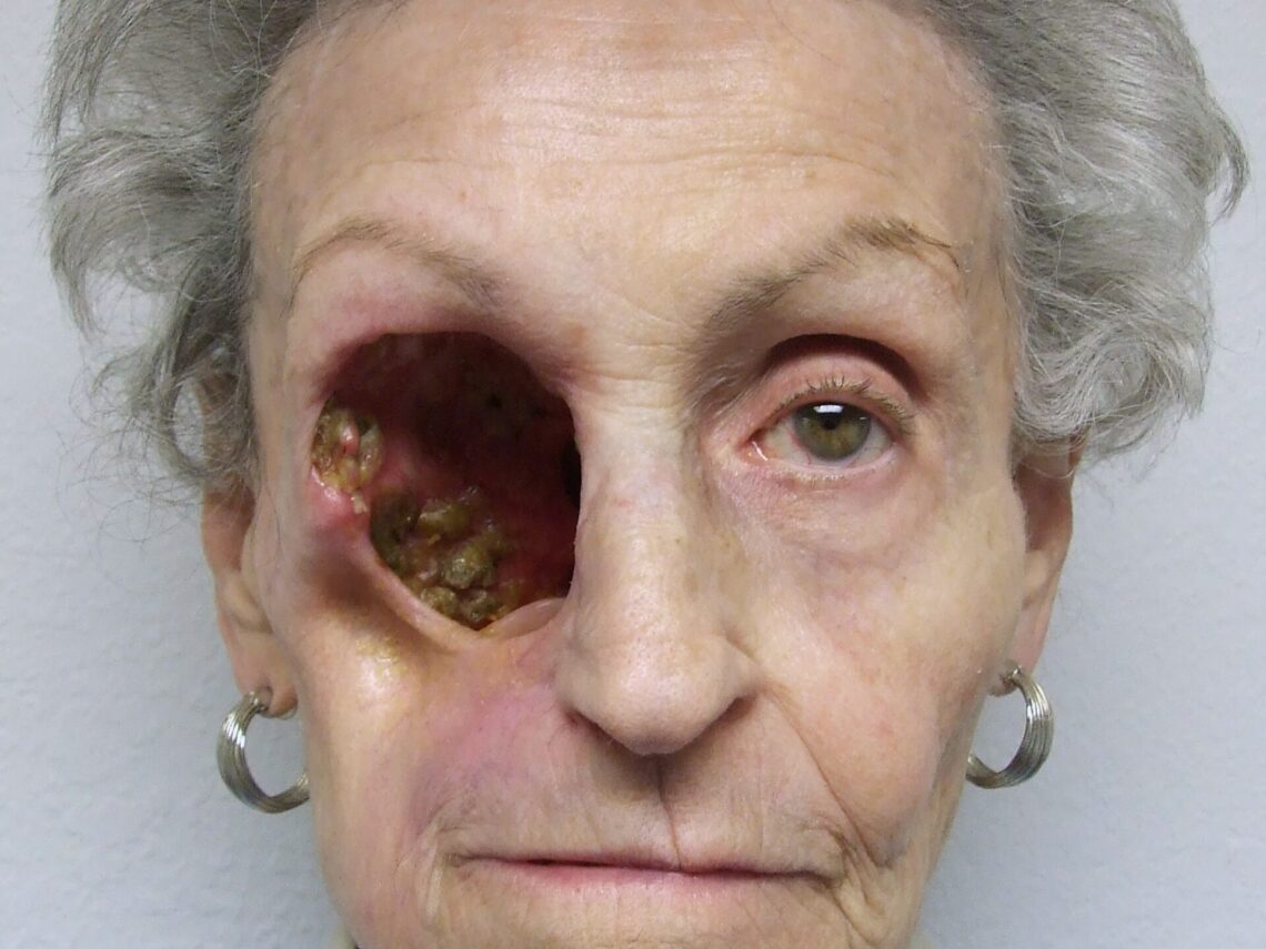 photo of hemi maxillectomy with orbital exenteration defect cavity