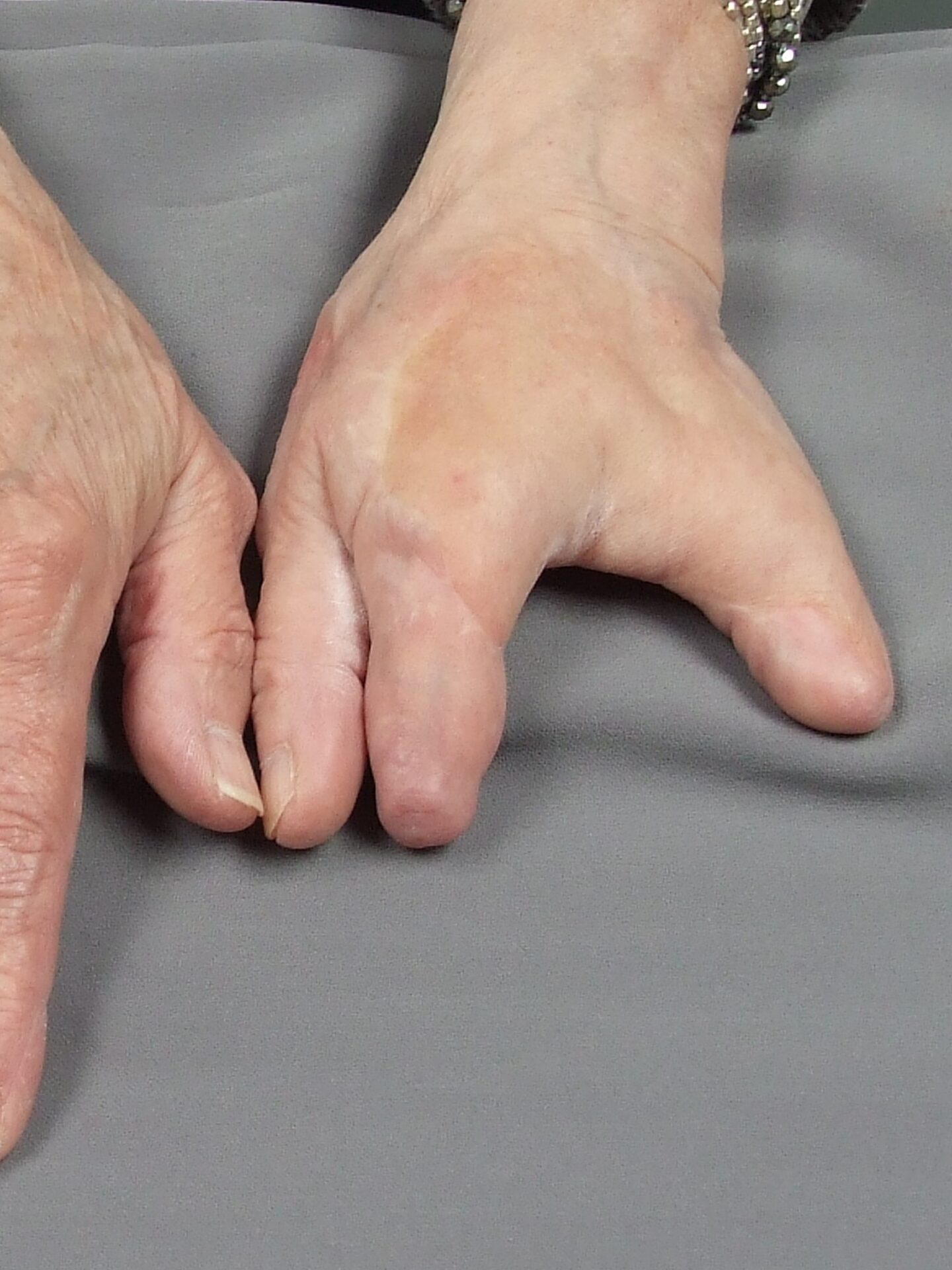 multiple fingers amputated on left hand