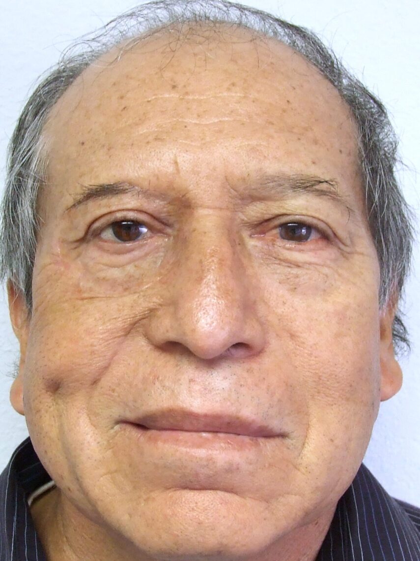 man wearing adhesive retained orbital prosthesis