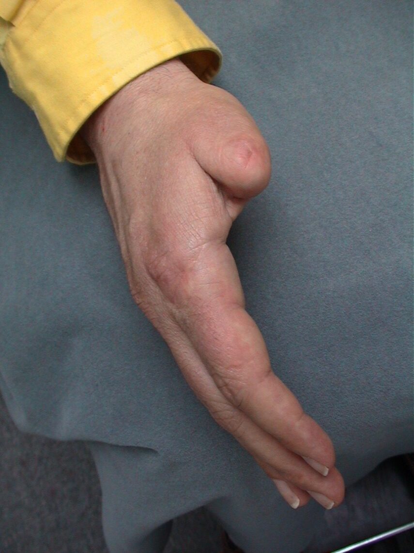 amputated my thumb picture