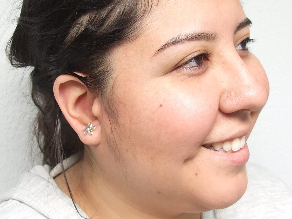 patient smiling after prosthetic operation