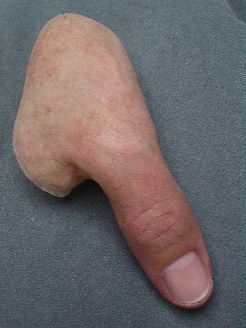 highly accurate custom Prosthetic thumb