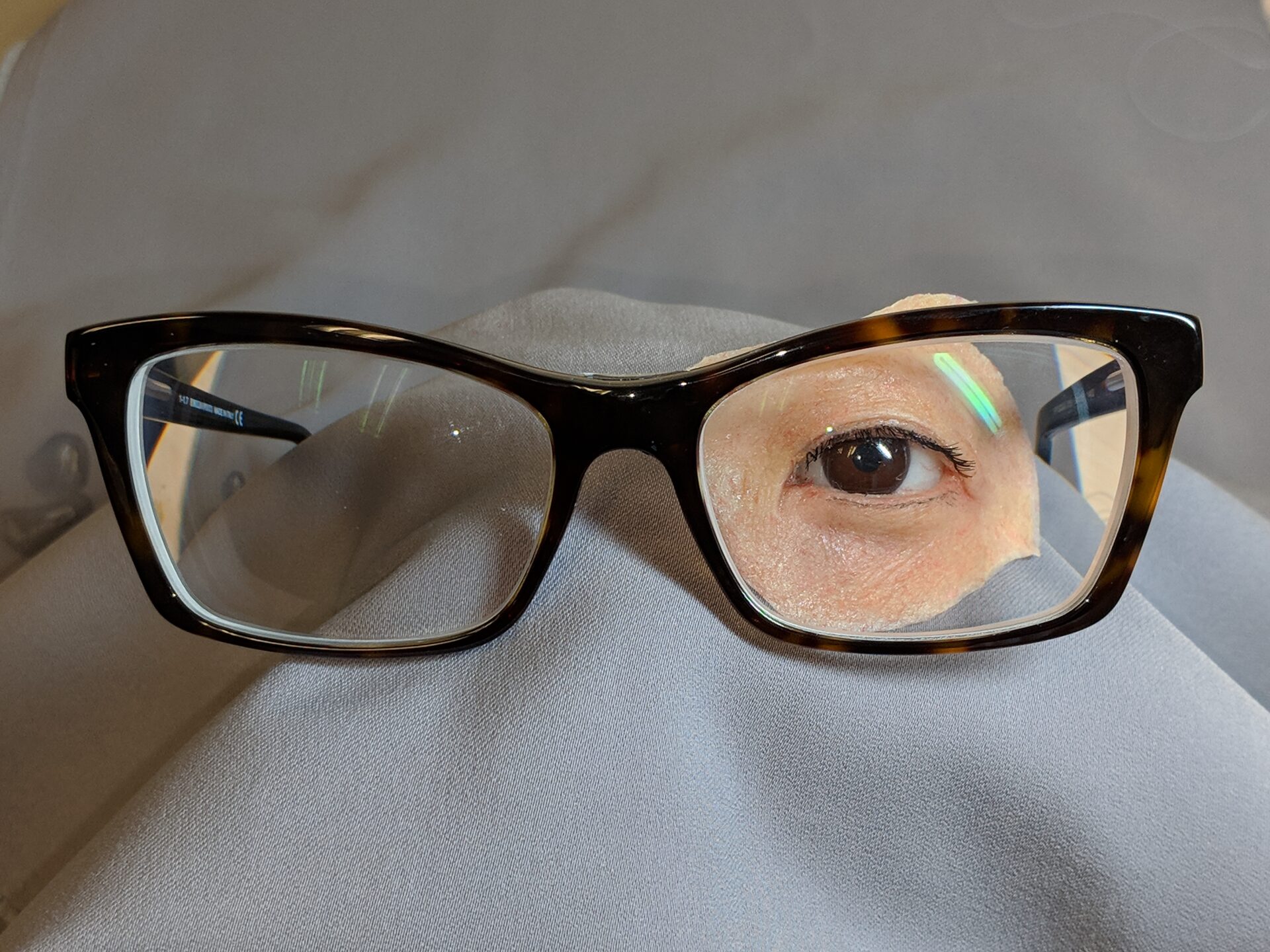 oculofacial prosthesis attached to glasses