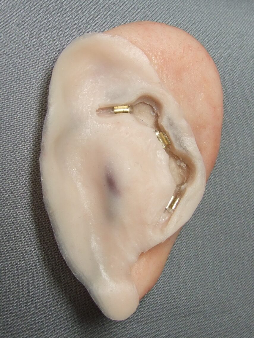 Bar clip ear prosthesis showing the clips on back