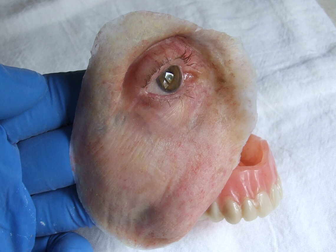 large maxillofacial prosthesis with artificial eye