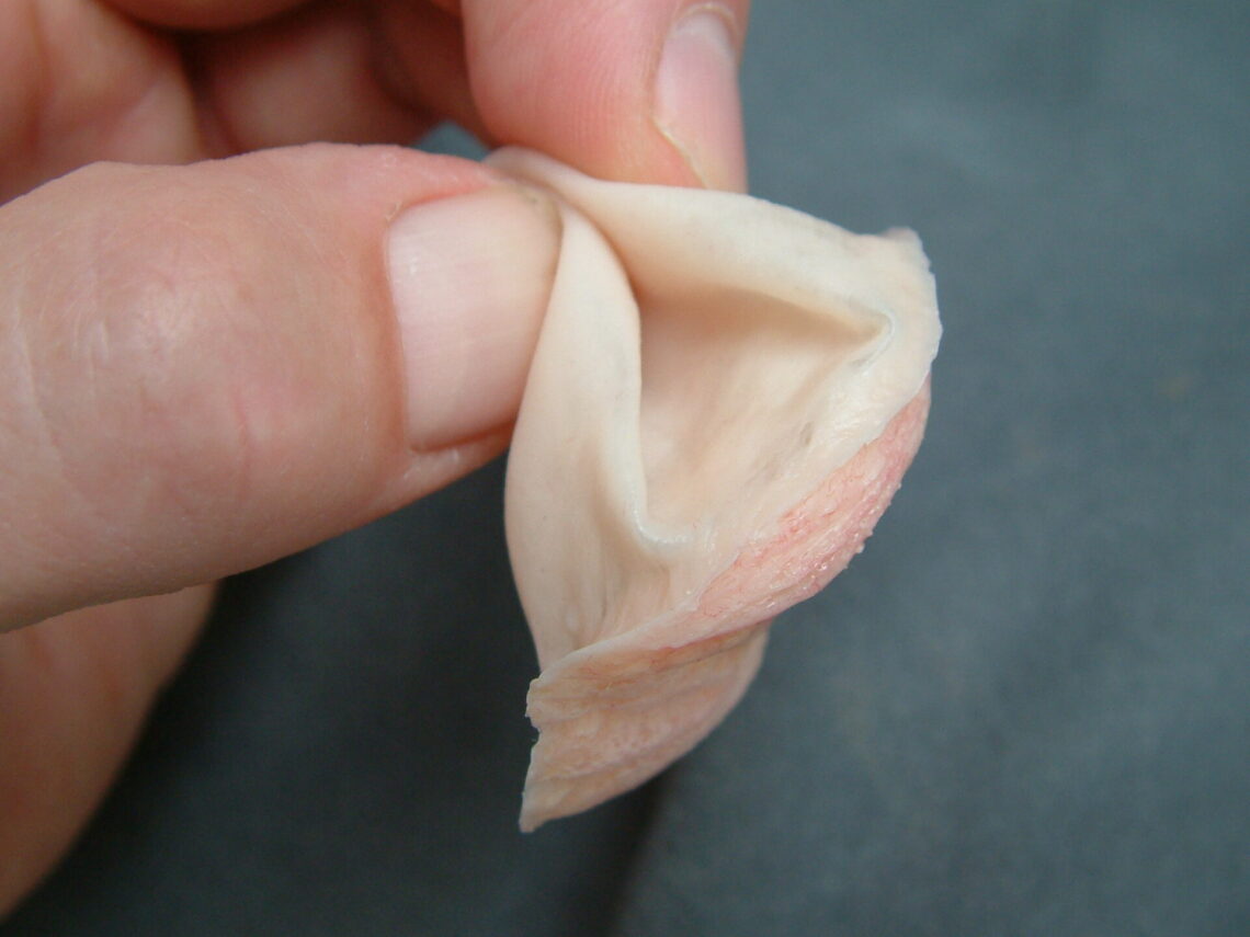 anatomical retention of orbital prosthesis eye