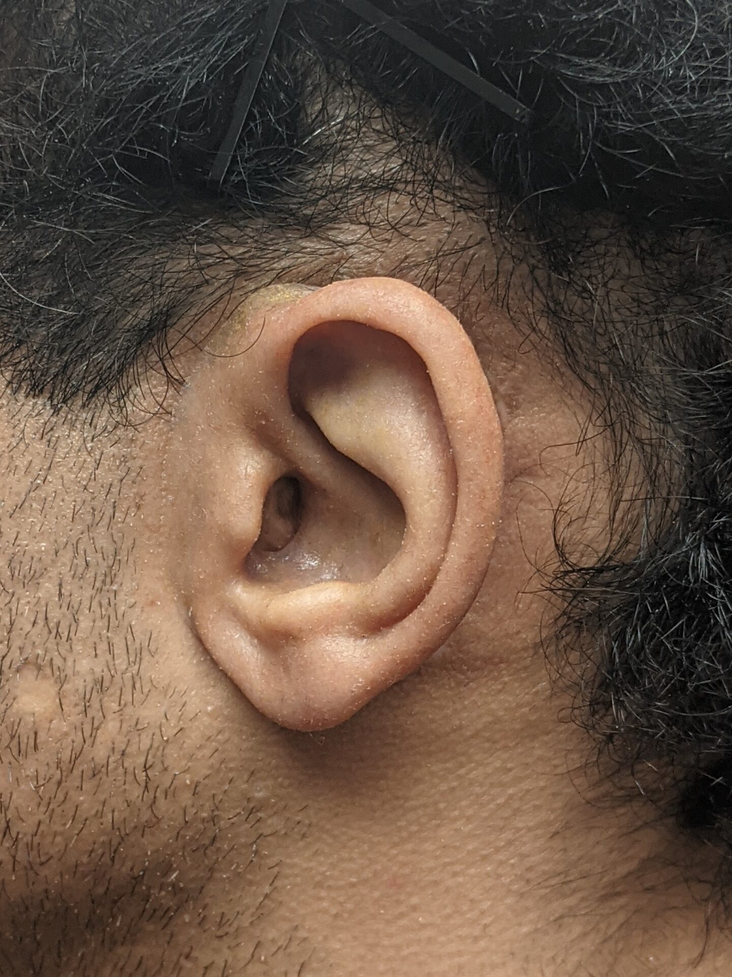 Close up photo of patient's new magnetic silicone ear prosthesis in place and seamlessly blending with surrounding skin