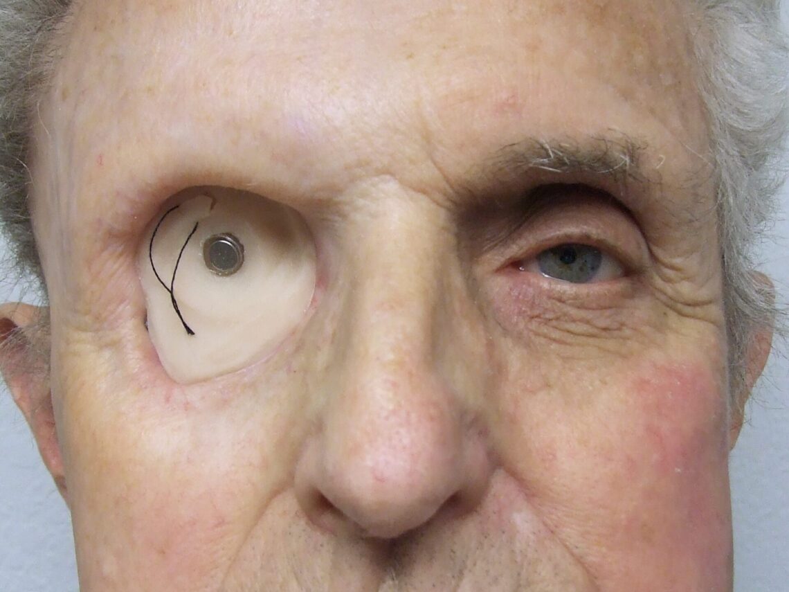 magnetic insert in exenteration cavity