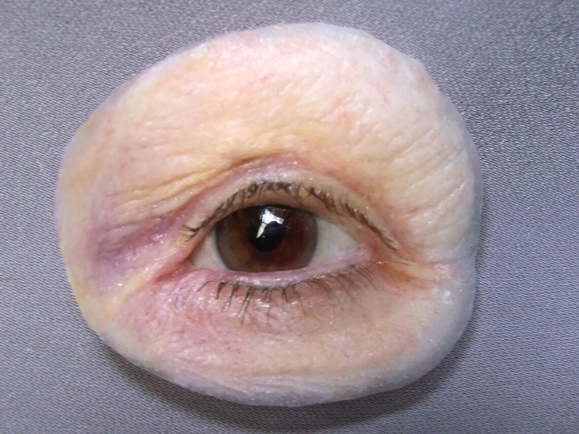 osseointegration orbital prosthesis