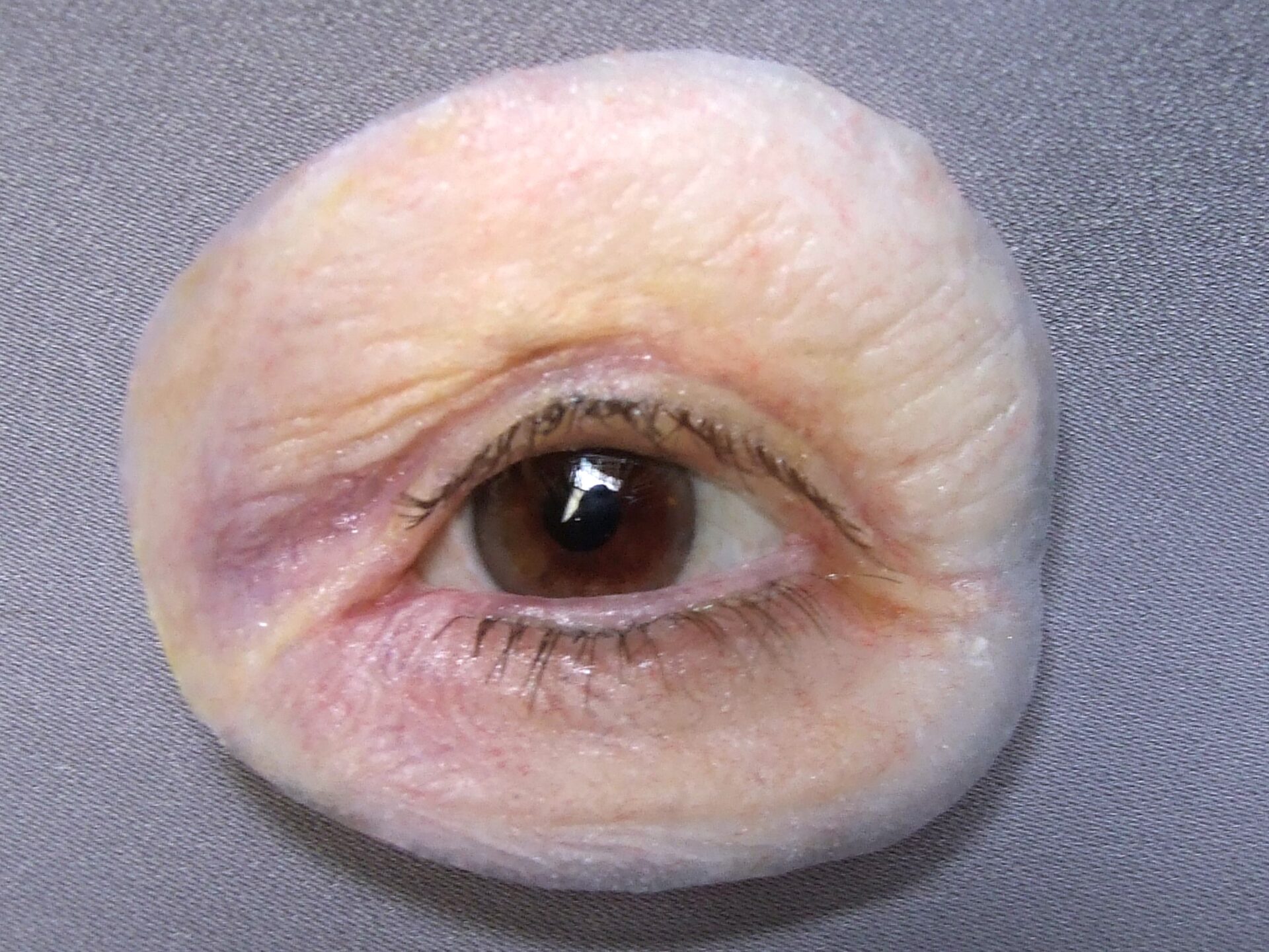 osseointegration orbital prosthesis