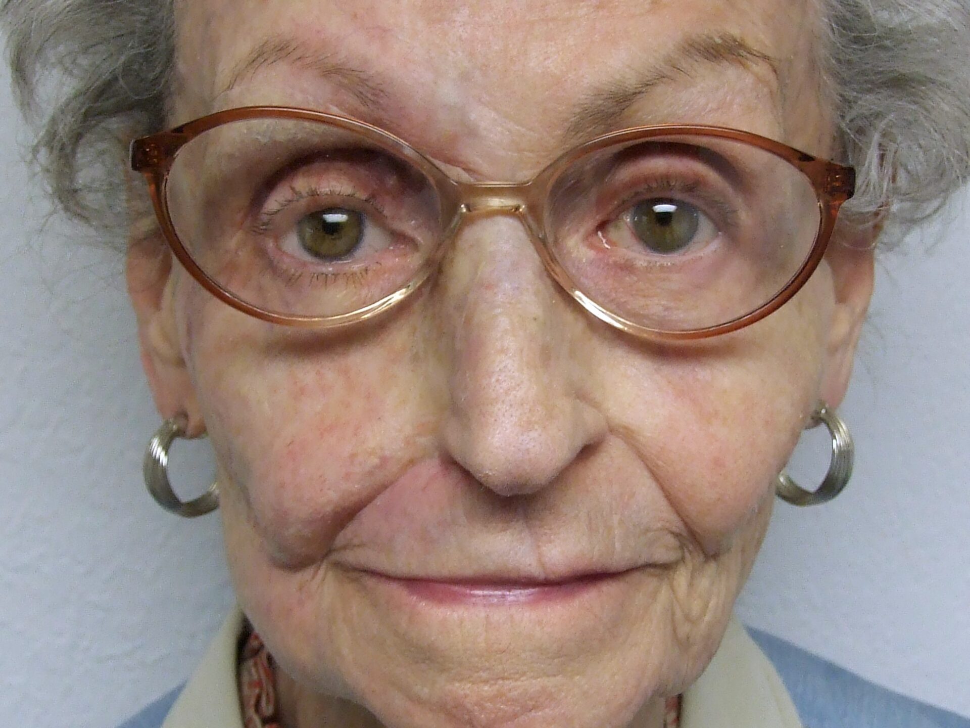 successful extraoral maxillofacial restoration prosthesis