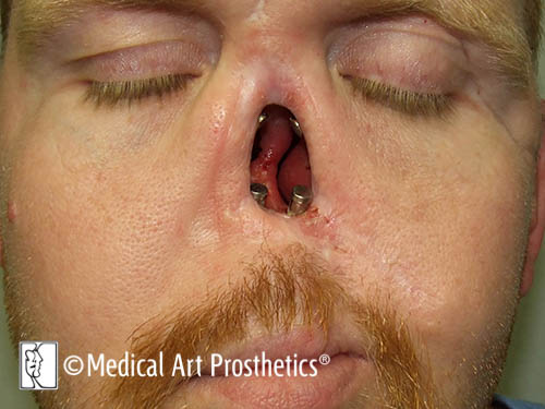 Patient not wearing his prosthetic nose