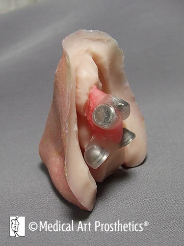 prosthetic nose