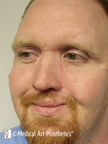 patient with prosthetic nose different angle