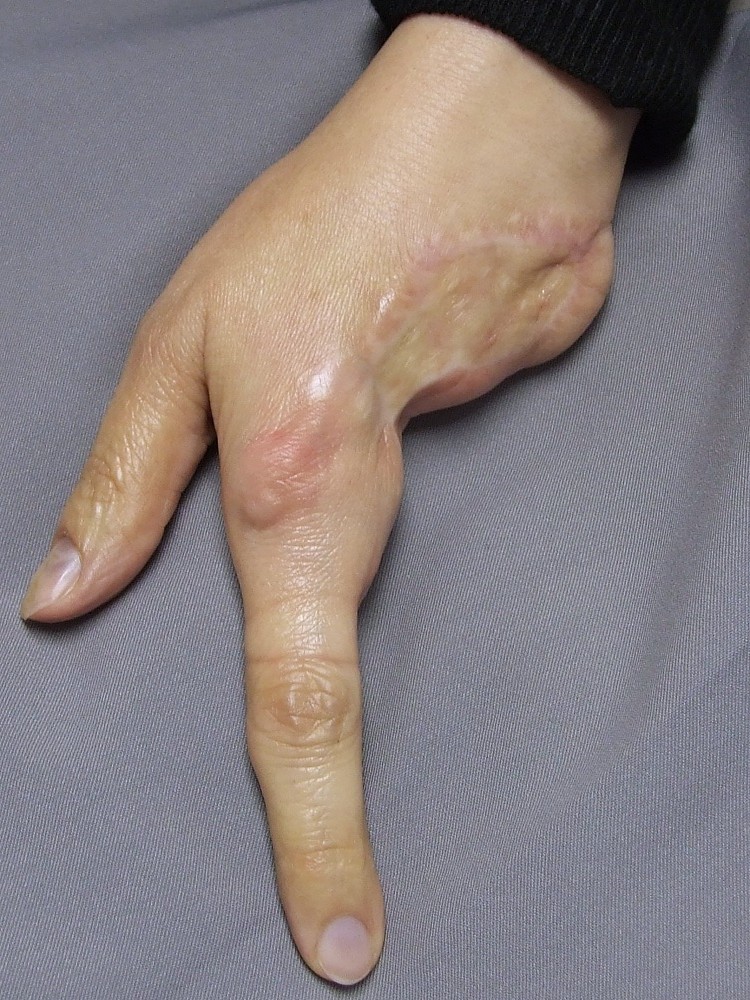 hand with 3 fingers amputated