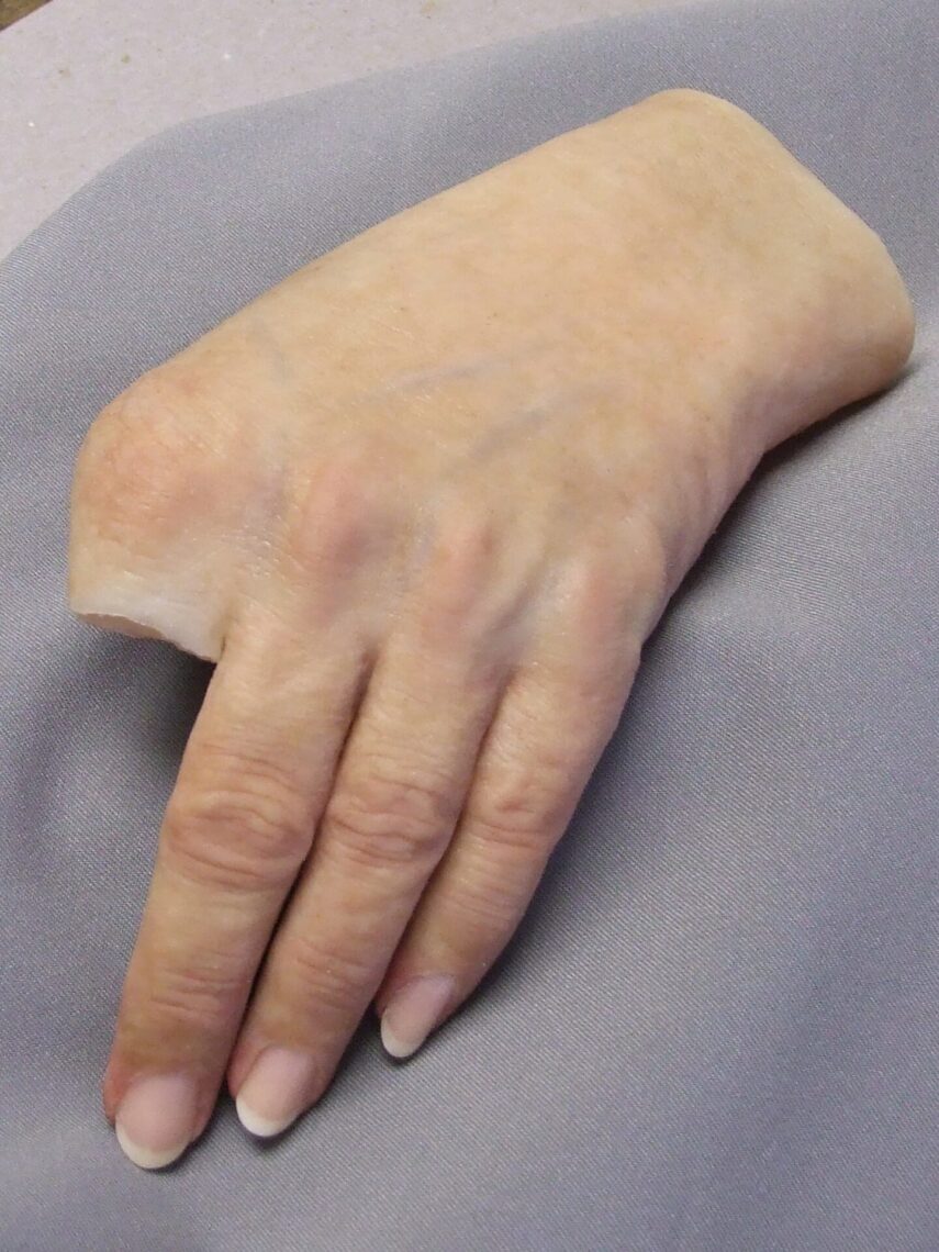 partial hand prosthetic