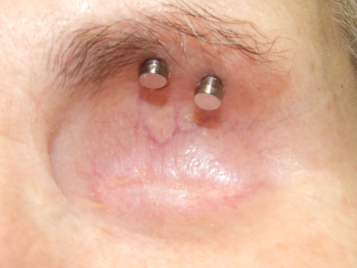 craniofacial osseointegration fixtures in supraorbital rim