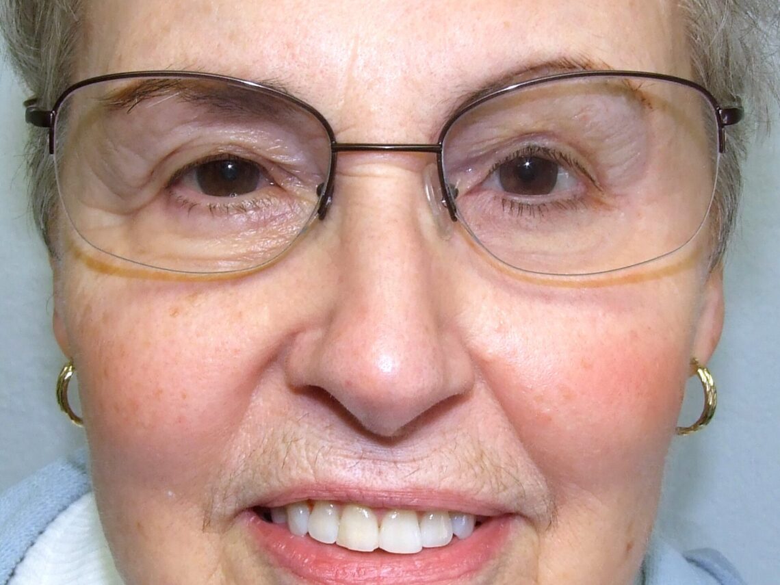 implant-retained orbital prosthesis