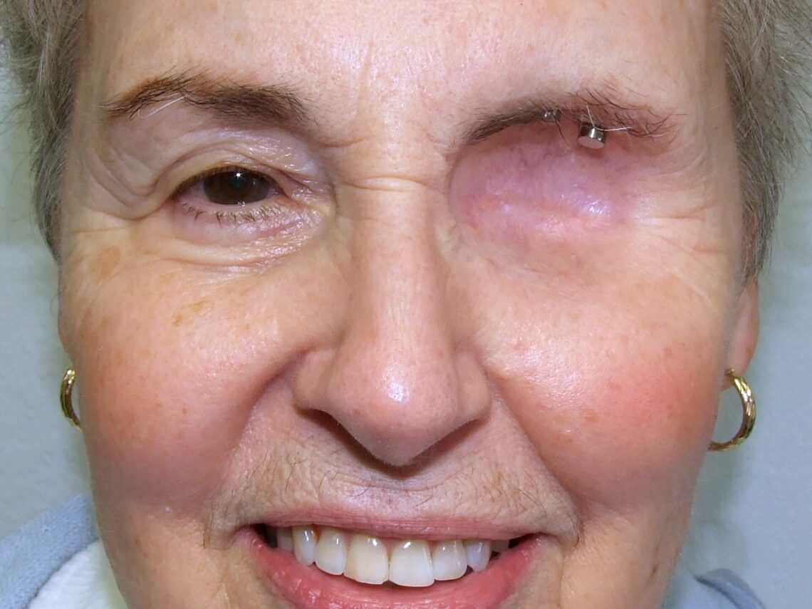 osseointegrated implants in supraorbital rim of exenteration cavity