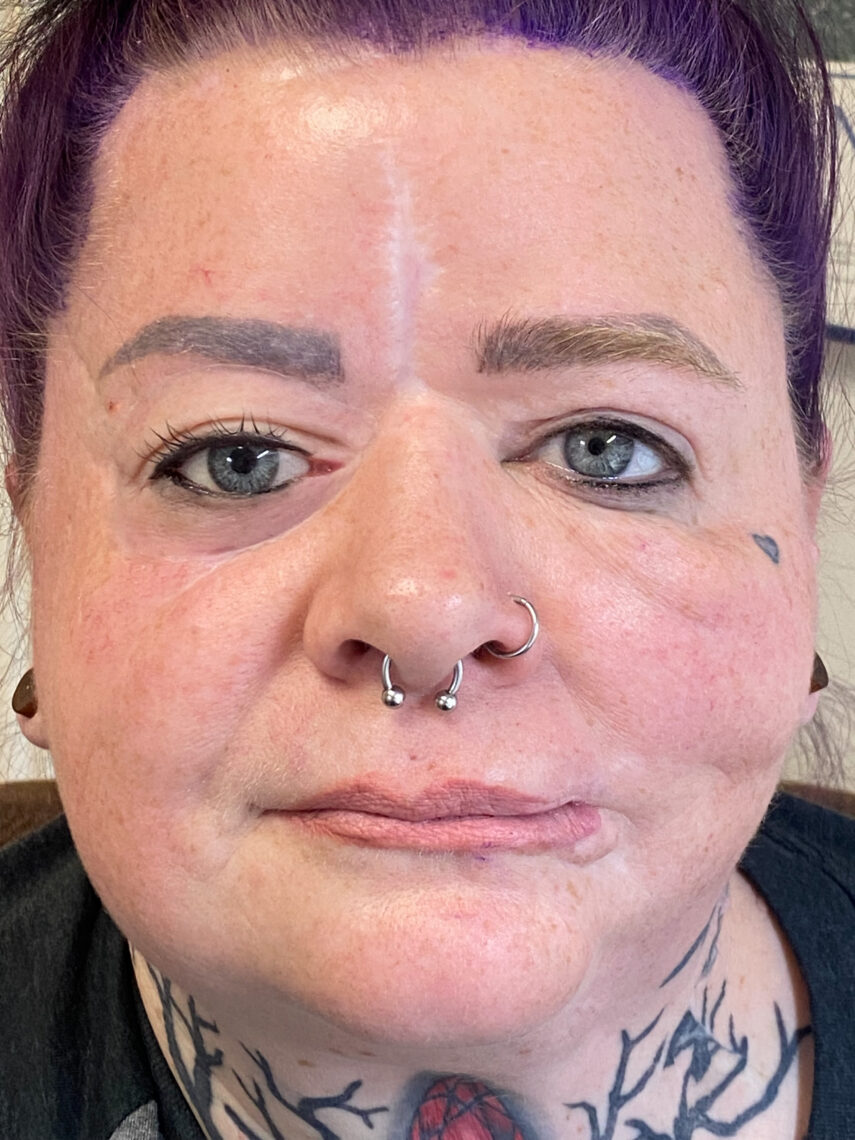 Image of patient who received a prosthetic eye